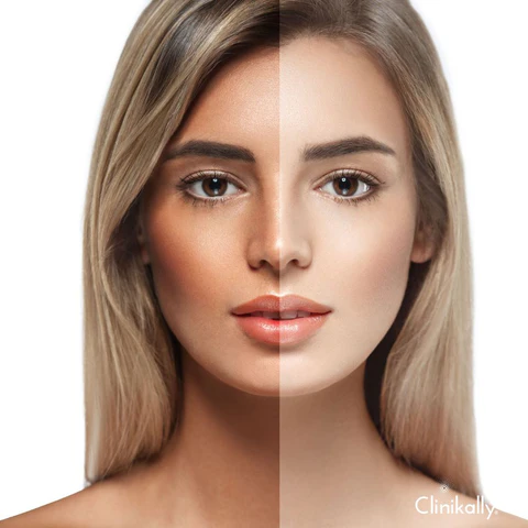 Tan Removal